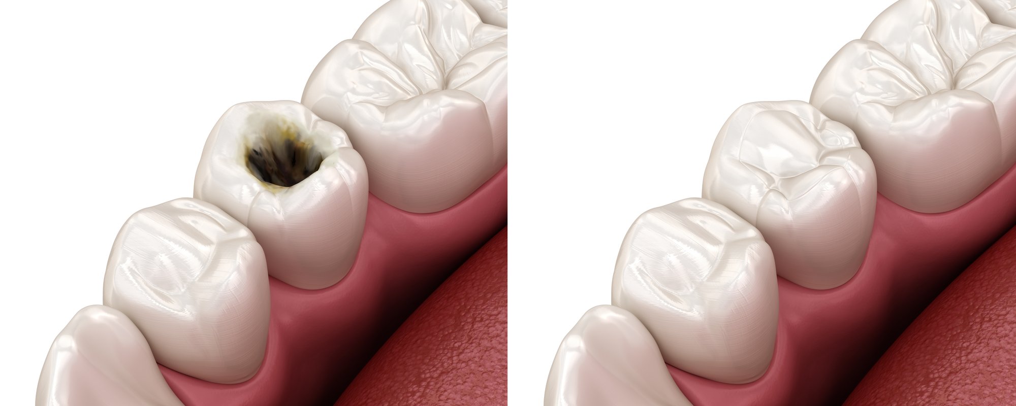 What Makes a Cavity Form Between Teeth?
